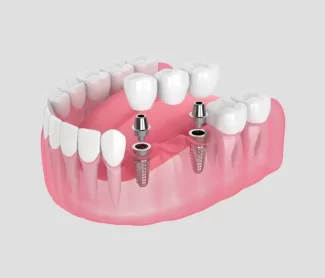 Dental Implants vs Dentures: Which Is Better for You?